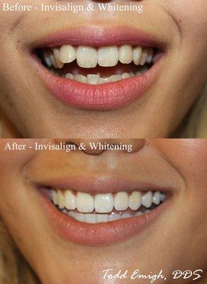 Invisalign, whitening, and some slight recontouring corrected the improper bite/function and made for a perfect smile!