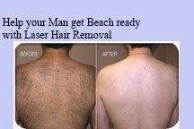 Laser Hair Removal