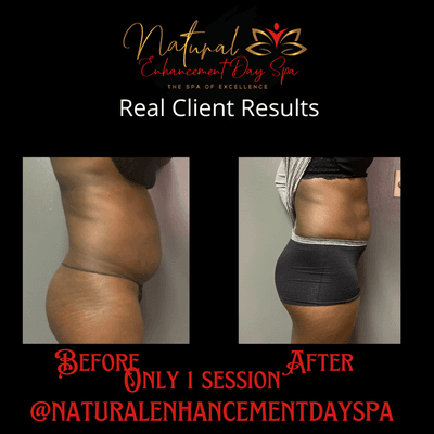 Laser Lipo & Cavitation results. #Resultsmatter