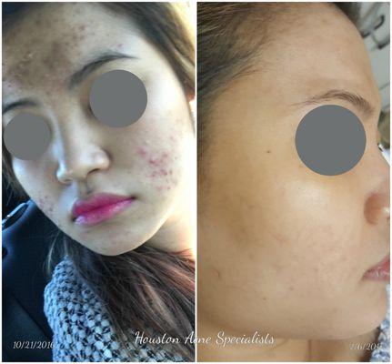 Its time to clear your skin from acne! Schedule your appointment for a consultation today!