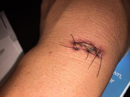 Boo on You!! Can't believe you won't take the stitches out! Epic Fail