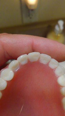 Foreign matter imbedded in Denture plate just below o Left tooth that is bigger and shaped different than rest of teeth