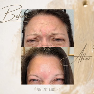 Before and after Botox treatment to relax forehead and frown lines (11s)