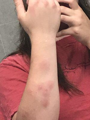 Bug bites.