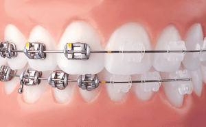 Ceramic Orthodontics