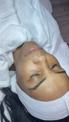 Dermaplaning