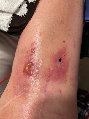 Sores from clots & fluid overload-lymph node damage. Quality of life now sucks! Carefully find your surgeon. Life can change quickly.