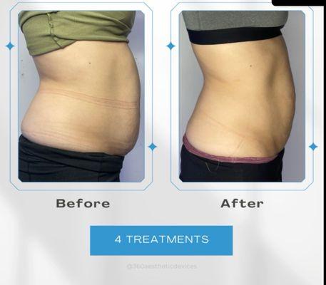 Our cryo slimming tool with muscle stimulation promotes revolutionary results in just a few treatments.  Get thin with no sagging