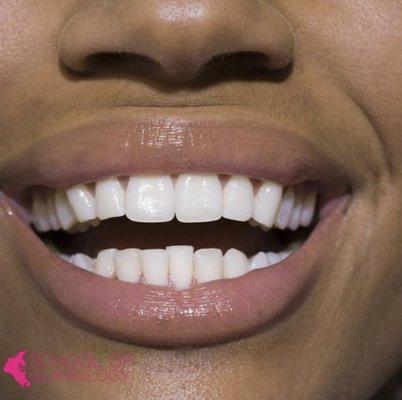 That sparkling smile is more achievable than you think! Get professional Teeth Whitening services at Glamology! Call to book!