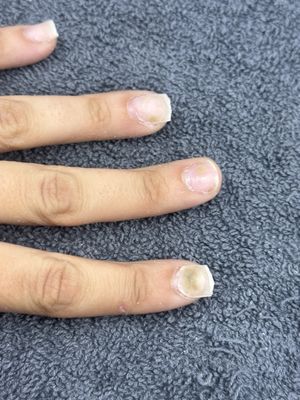 Unsanitary nail services and preparation