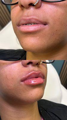 Lip Filler enhancement