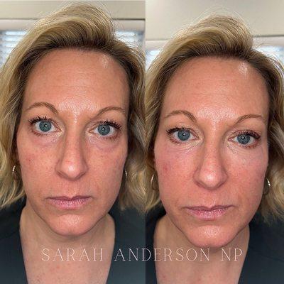 Undereye filler before/after