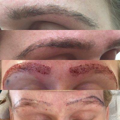 Eyebrow transplant -- From bottom up:  Before, Immediately after transplant, 6 months after transplant (2 angles)