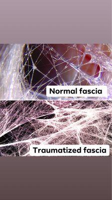 Traumatized fascia vs. normal fascia.