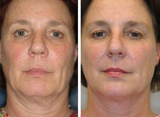 Thermage face tightening treatment