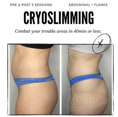 CryoContouring