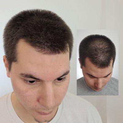 Scalp Micro Pigmentation to make hair look thicker in Austin, Texas