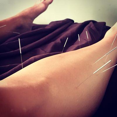 Acupuncture Treatment for Runners.