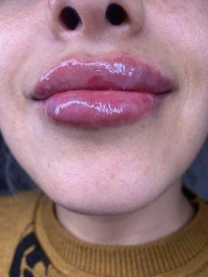 Lips filler