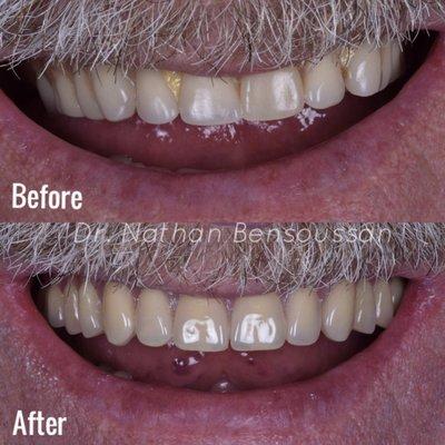 For this patient, Implants were used to improve his chewing ability and esthetics.