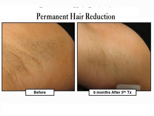 Hair Removal