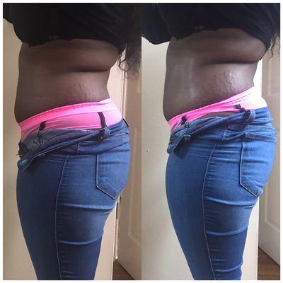 Laser Lipo results after 1 treatment!