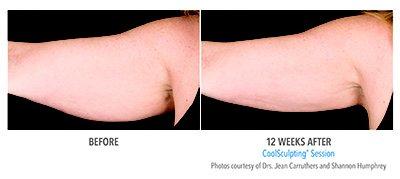 CoolSculpting before and after