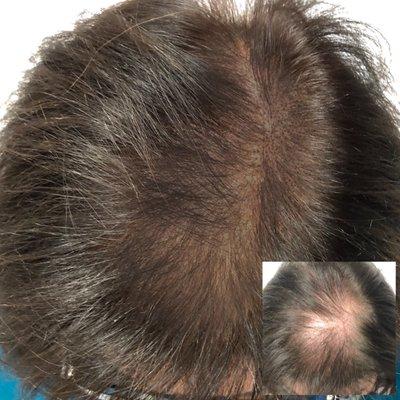 Scalp tattoo for density in thinning hair