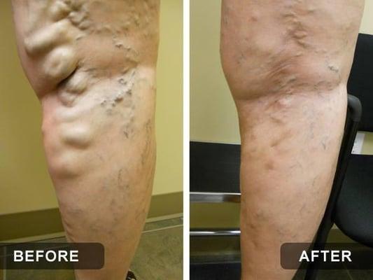 BEFORE & AFTER LASER ABLATION & REMOVAL OF VARICOSE VEINS