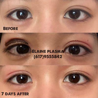 Correct upper eyelid by plasma pen fibroblast