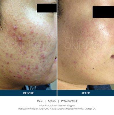 Controlling your acne with treatment plans customized for your skin