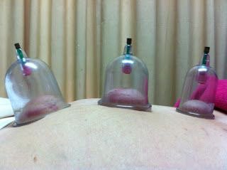 Cupping Treatment helps chronic pain relief and feel better after.