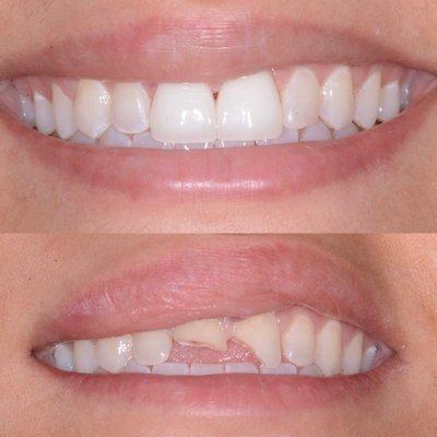 How just a couple teeth can make for a complete transformation. This outstanding patient took a terrible fall just before her wedding.