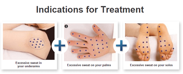 Therapeutic treatments for primary hyperhidrosis (excessive sweating) of face, scalp, hands, feet, and armpits.