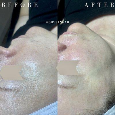 Results of a Signature Facial + Hydrojelly Mask