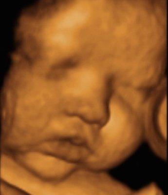 Life Meant to Live 3D/4D Ultrasound, approximately 35 weeks gestation