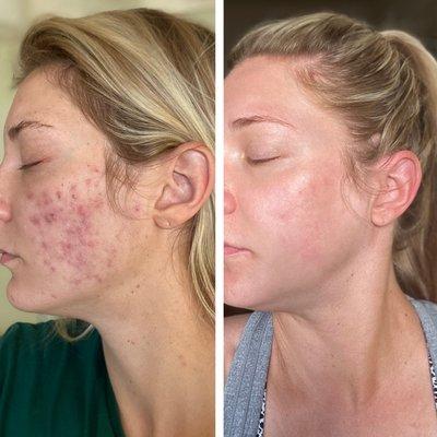 "I could not have even begun to imagine that my skin could be this healthy after the intense breakouts I experienced 6 months ago." -Abbie