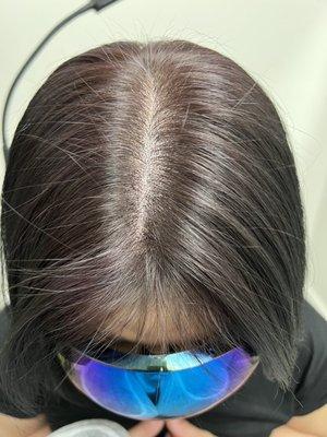 My client Annie's AFTER top scalp photo, Density Session 1.