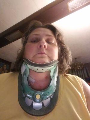 After surgery wearing my collar brace for 6 weeks.