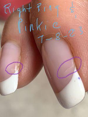 Finger nails breaking below the quick