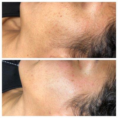 Dermaplane: before & after