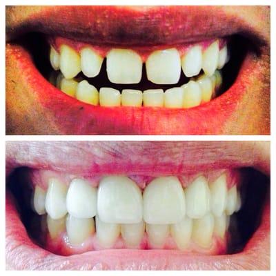 My before and after. Great experience and an amazing dentist!