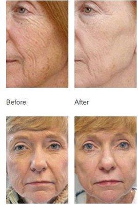 Wrinkles and skin rejuvenation