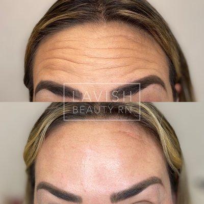 Botox for reducing forehead wrinkles