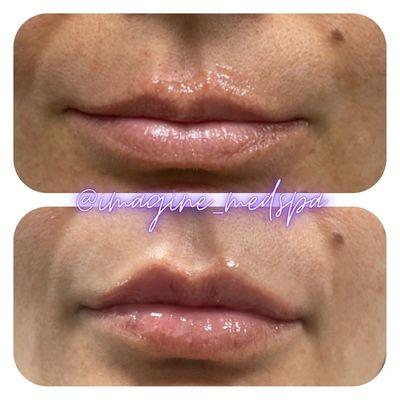 Lip fillers address:

 Uneven lip shape

 Wrinkles around the mouth

 Smoker's lines

 An undefined vermilion border