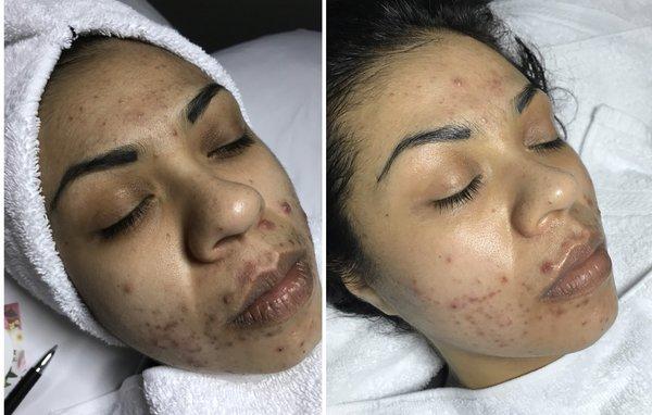 Treatment Facials. Two months in and her skin look even better now, check out my instagram for the most recent progress.