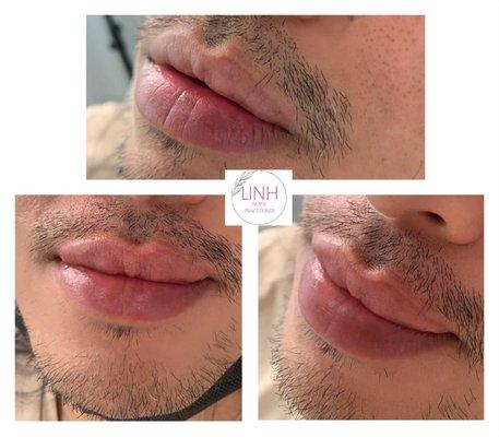 Men lip filler