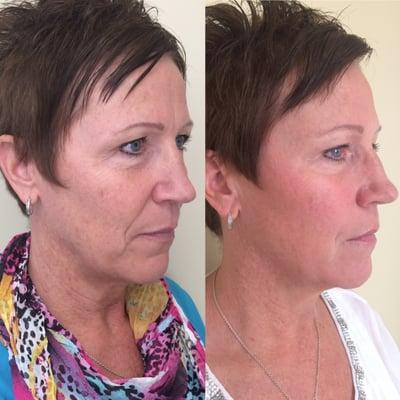 Dermal filler, Voluma, lifting the cheek bones with Juvederm around the mouth to soften fine smile lines. Injected by Dr. Guy!