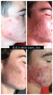 From serious acne to seriously beautiful skin.   His parents fly him to d.d. for better skin.  Physicians trust their children to her.