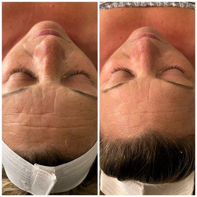 Lymphatic drainage facial